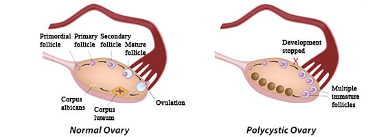 pcos